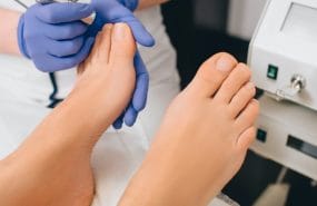 Lazer İle Tırnak Mantarı Tedavisi